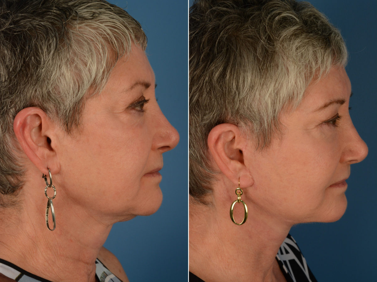 Endoscopic Facelift Before and After Photos in Naples, FL, Patient 14226