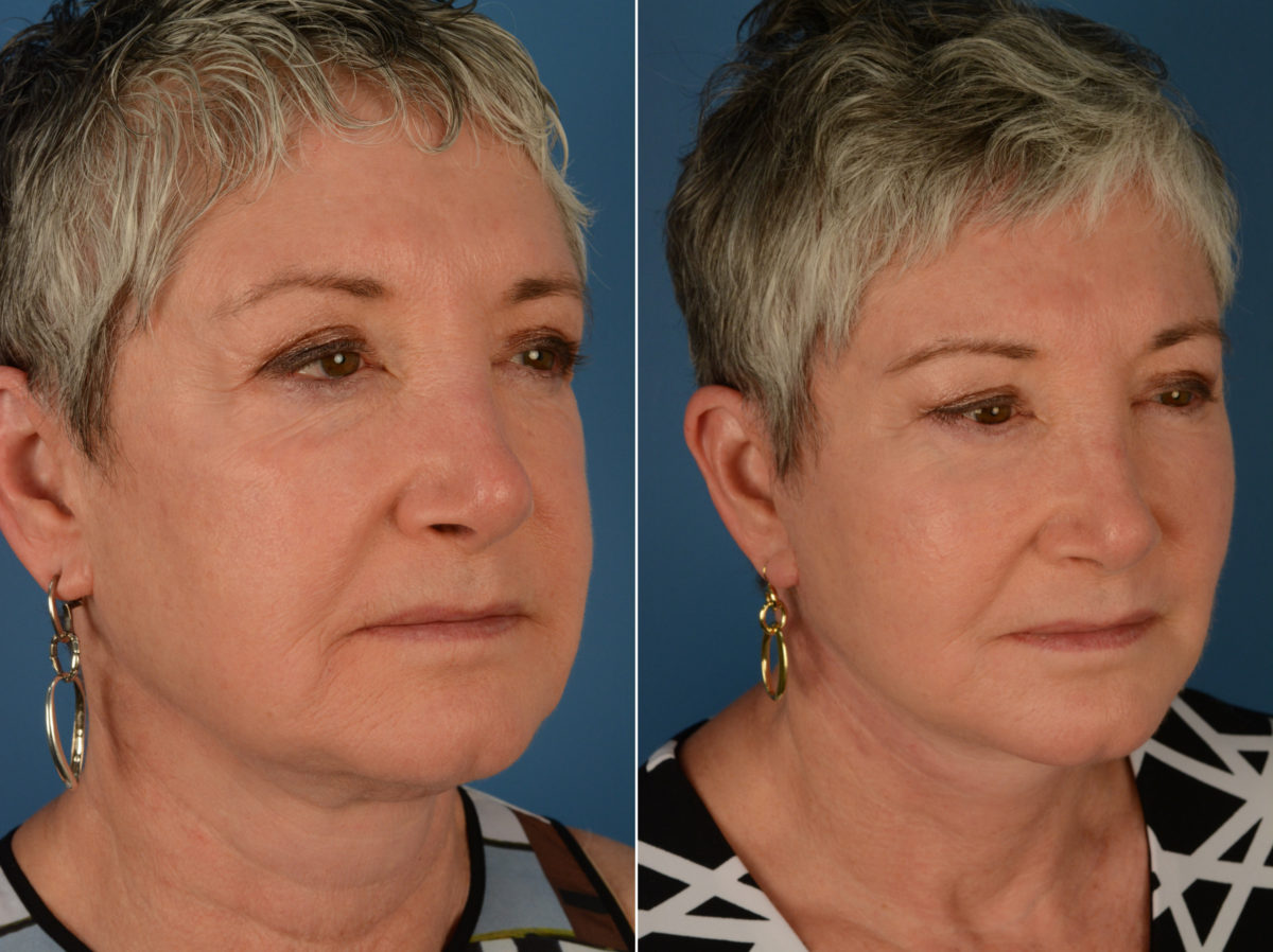 Endoscopic Facelift Before and After Photos in Naples, FL, Patient 14226