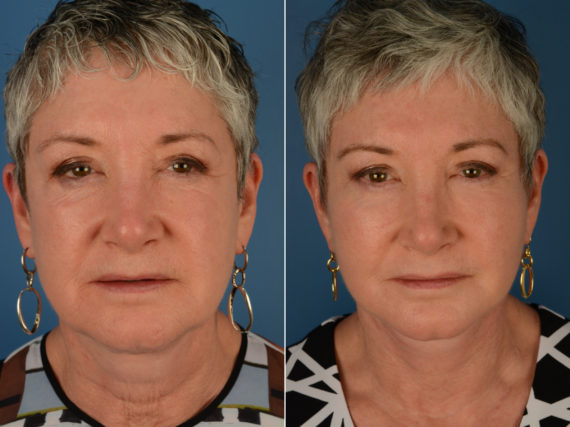 Endoscopic Facelift Before and After Photos in Naples, FL, Patient 14226