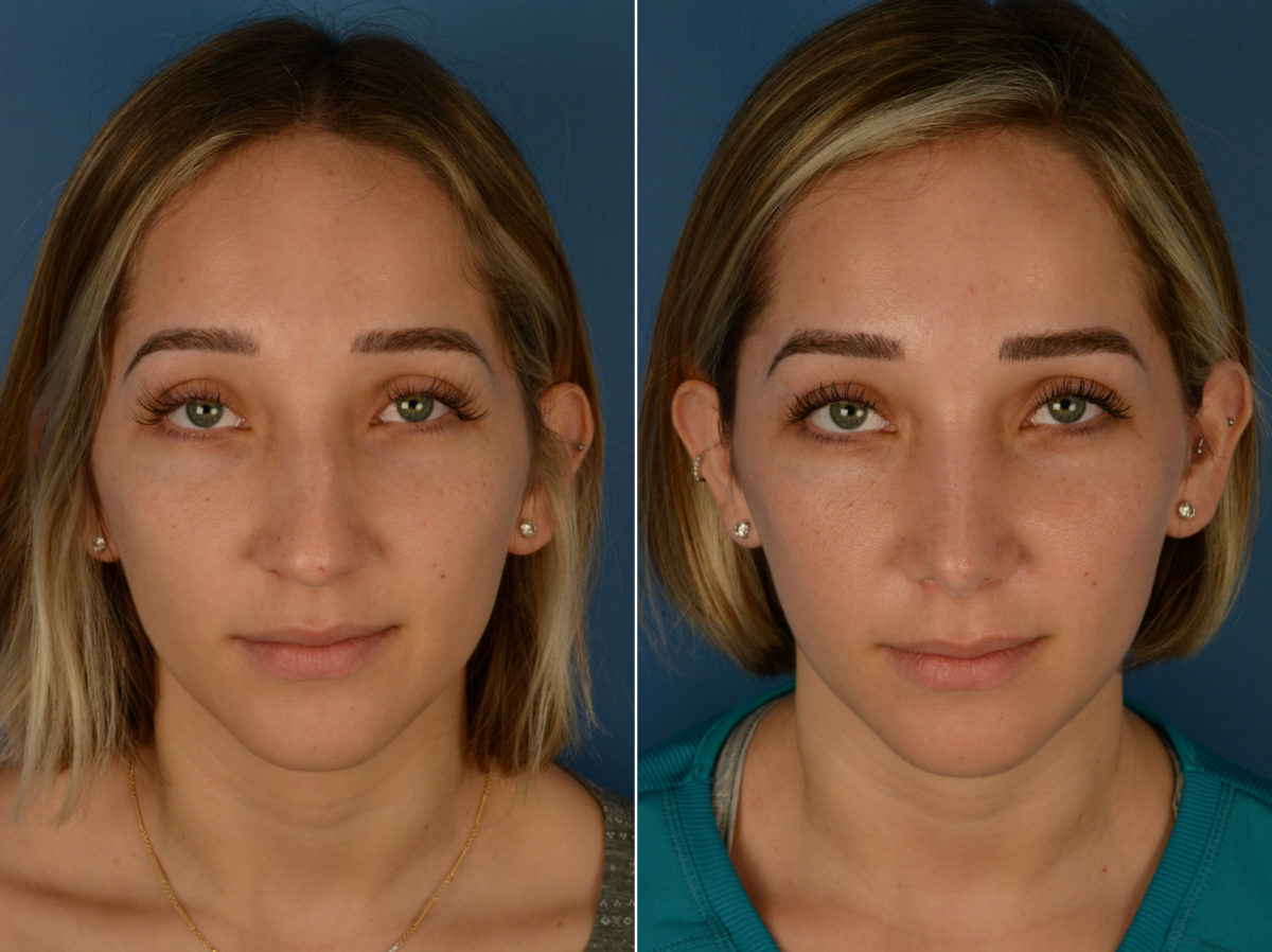 Rhinoplasty Before and After Photos in Naples, FL, Patient 14246