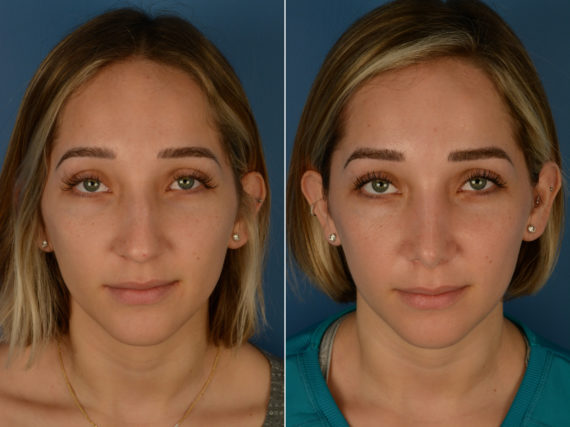Rhinoplasty Before and After Photos in Naples, FL, Patient 14246