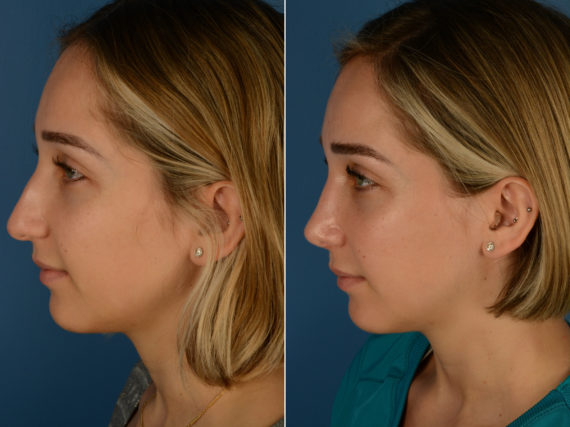 Rhinoplasty Before and After Photos in Naples, FL, Patient 14246