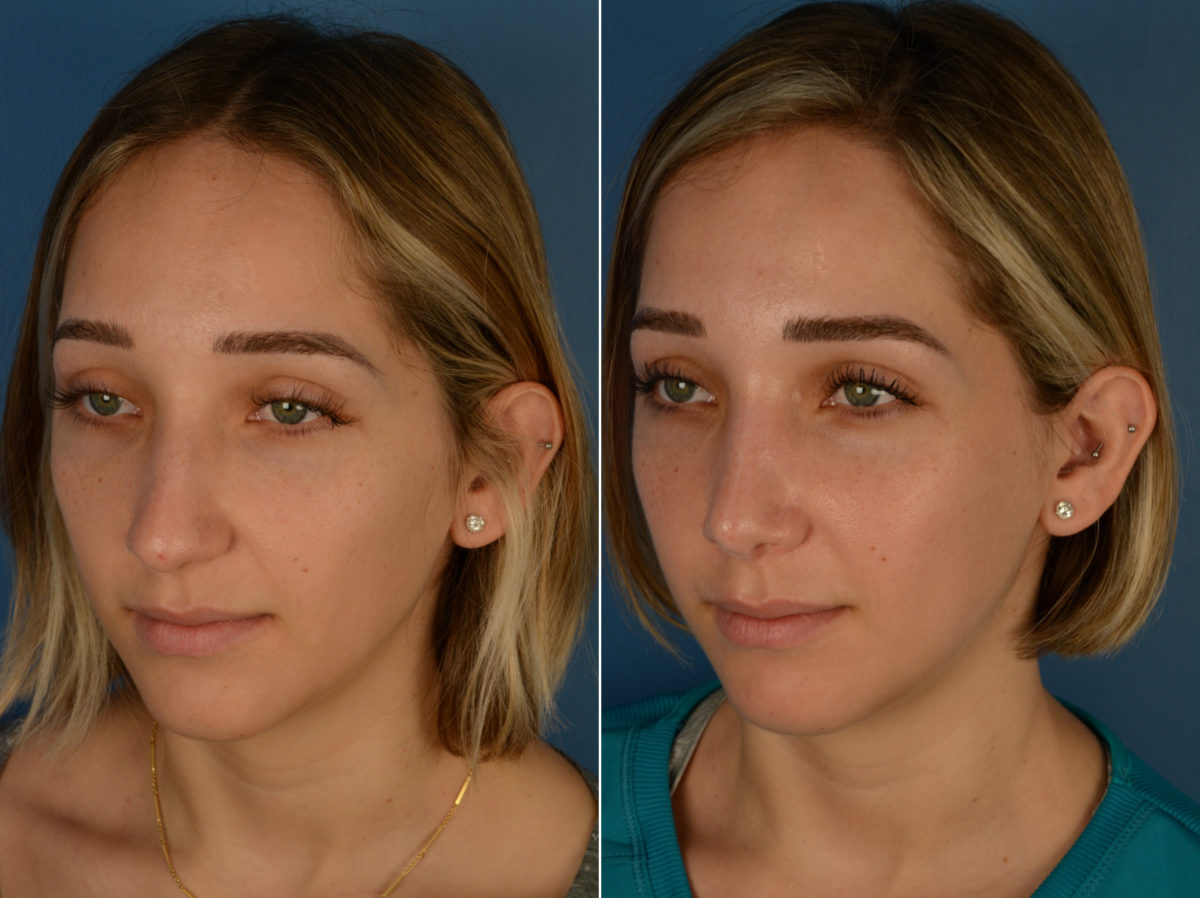 Rhinoplasty Before and After Photos in Naples, FL, Patient 14246