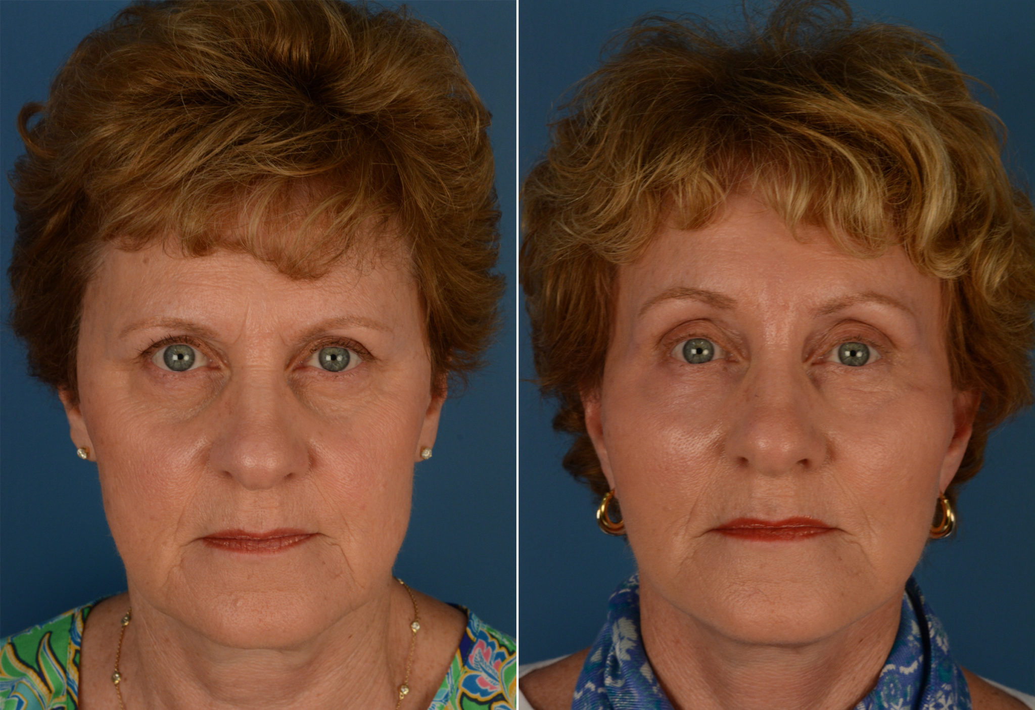 Endoscopic Facelift photos Page 2 of 6 Aesthetic Surgery Center