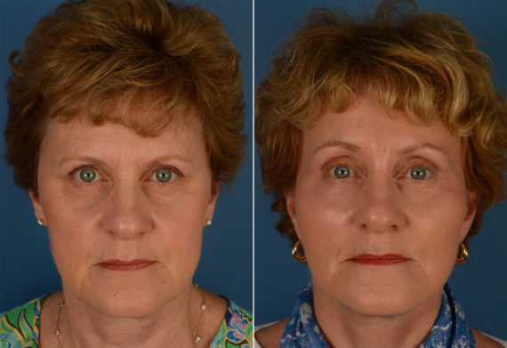 Endoscopic Facelift Before and After Photos in Naples, FL, Patient 14364