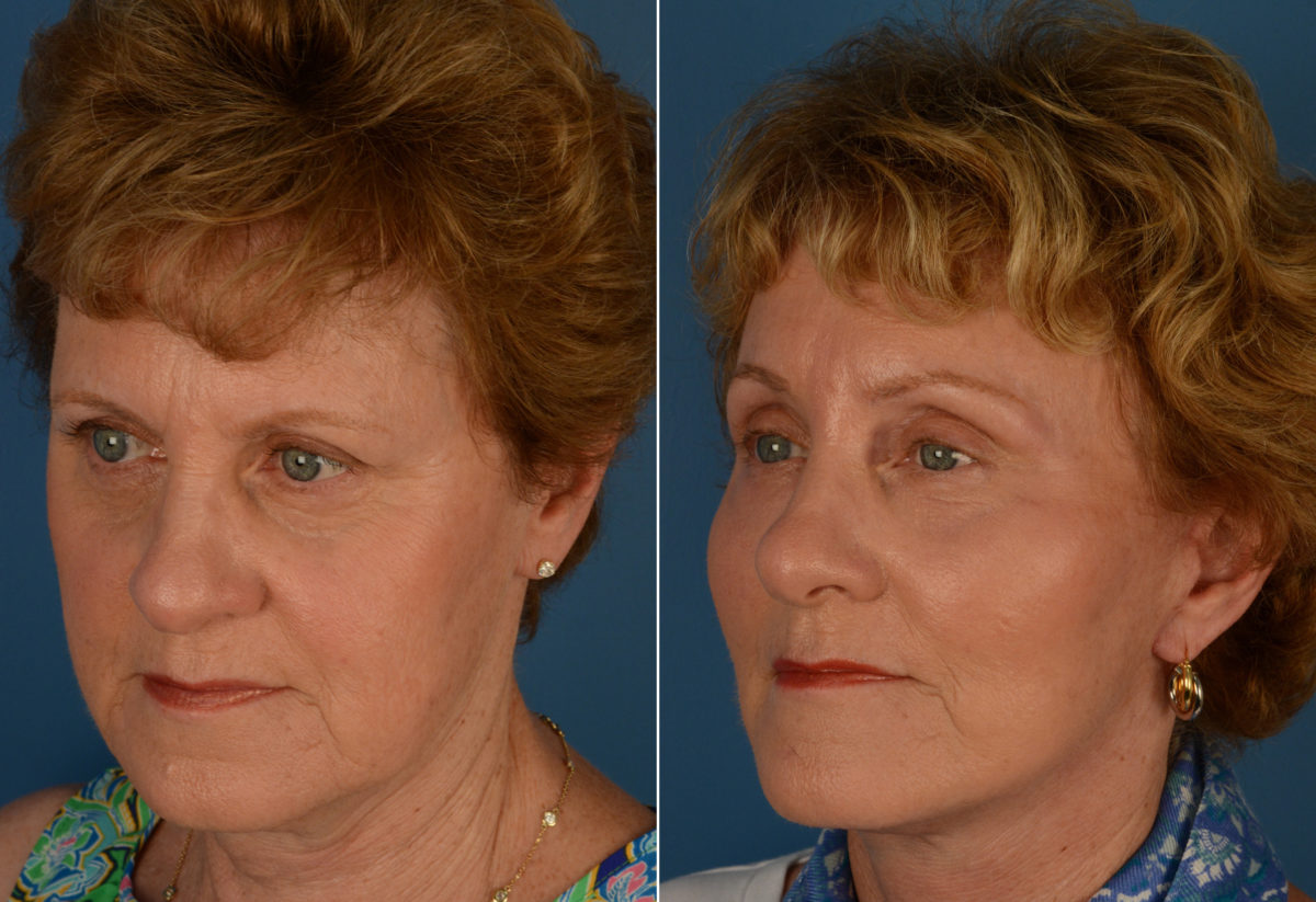 Endoscopic Facelift Before and After Photos in Naples, FL, Patient 14364