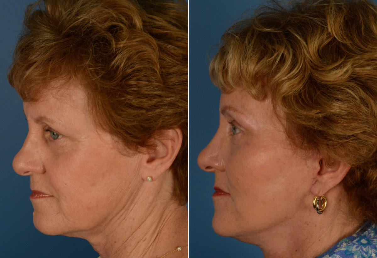 Endoscopic Facelift Before and After Photos in Naples, FL, Patient 14364