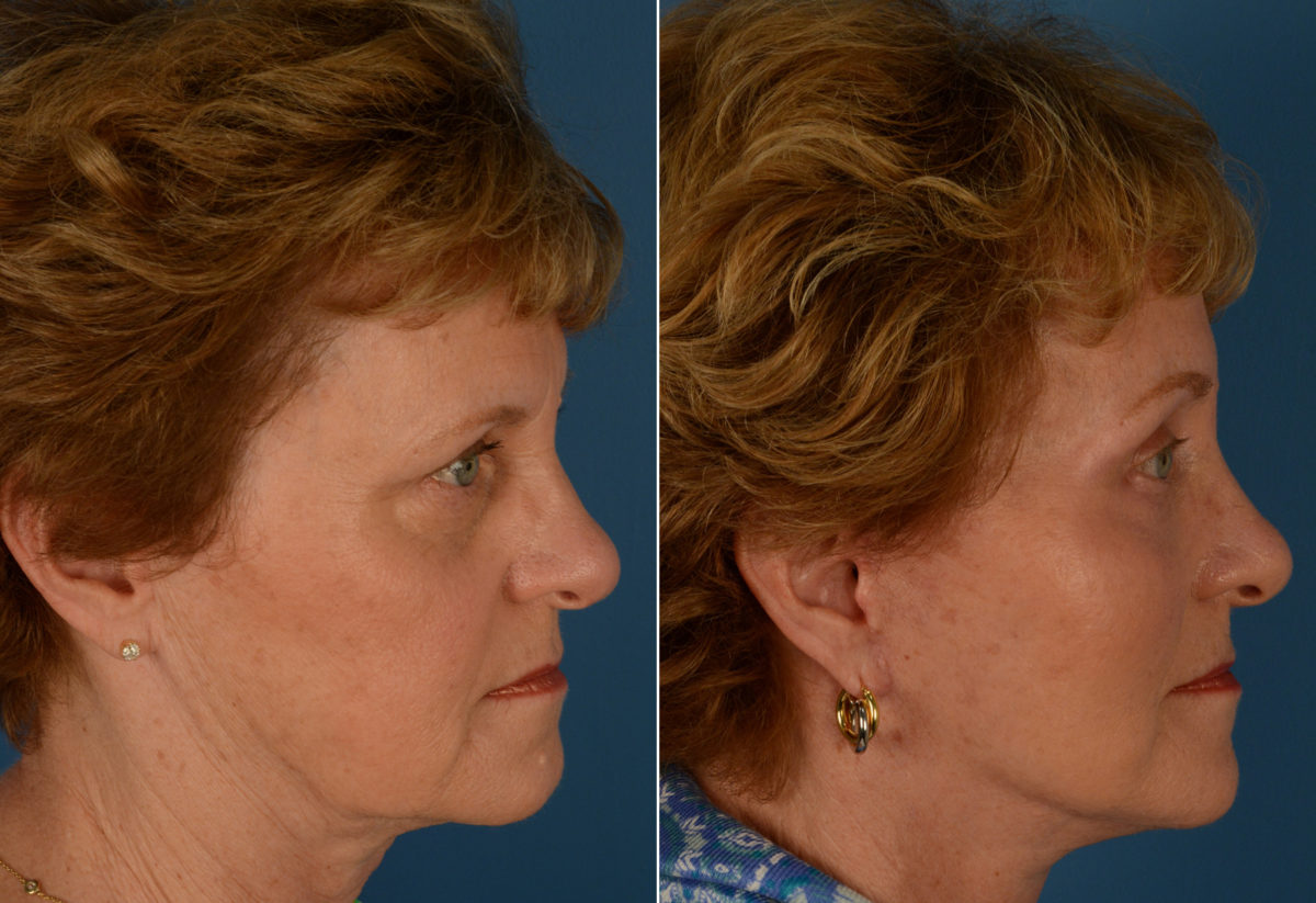 Endoscopic Facelift Before and After Photos in Naples, FL, Patient 14364