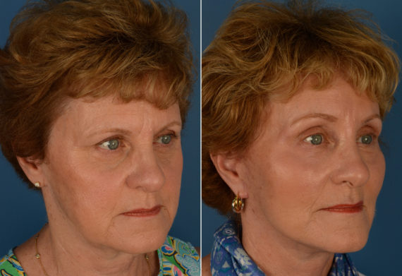 Endoscopic Facelift Before and After Photos in Naples, FL, Patient 14364
