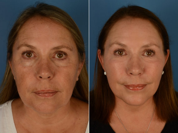 Endoscopic Facelift Before and After Photos in Naples, FL, Patient 14390
