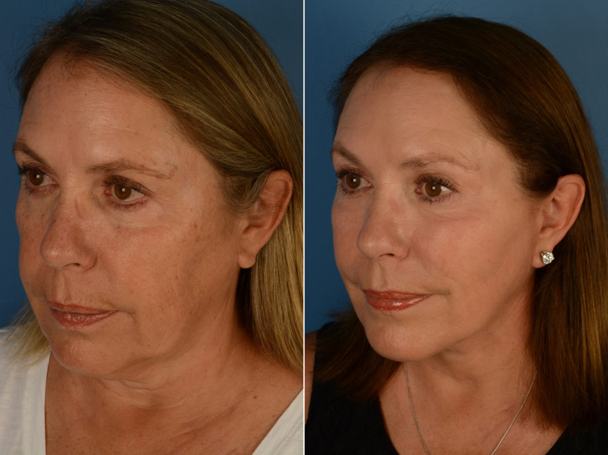 Endoscopic Facelift Before and After Photos in Naples, FL, Patient 14390