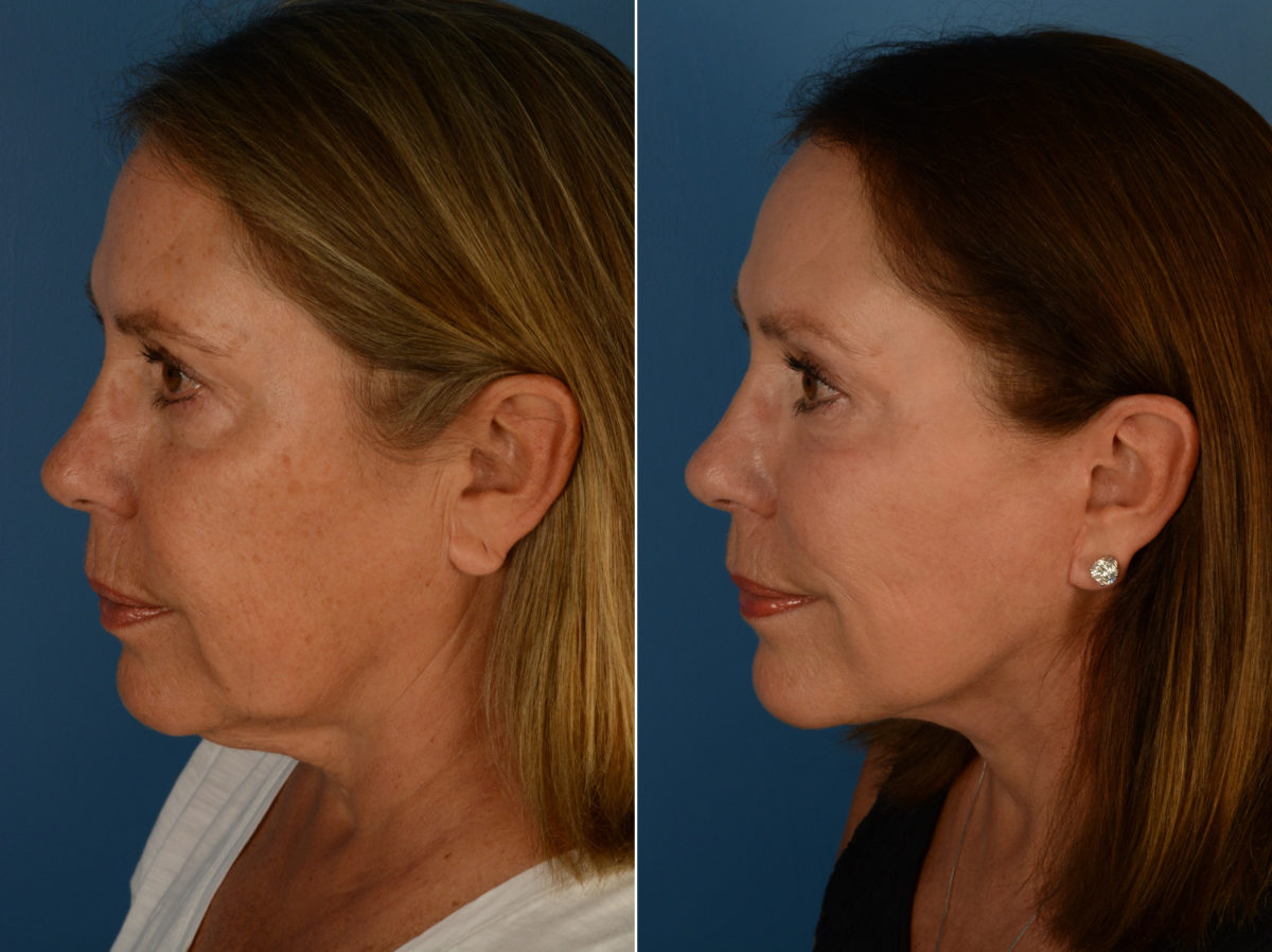 Endoscopic Facelift Before and After Photos in Naples, FL, Patient 14390