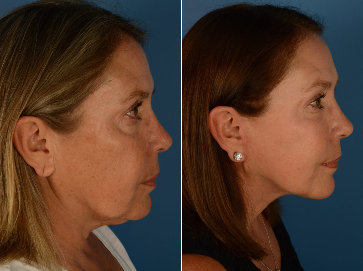Endoscopic Facelift Before and After Photos in Naples, FL, Patient 14390