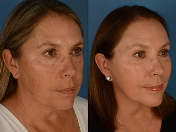 Endoscopic Facelift Before and After Photos in Naples, FL, Patient 14390