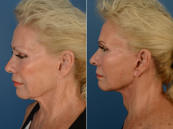 Cheek Implants Before and After Photos in Naples, FL, Patient 14446