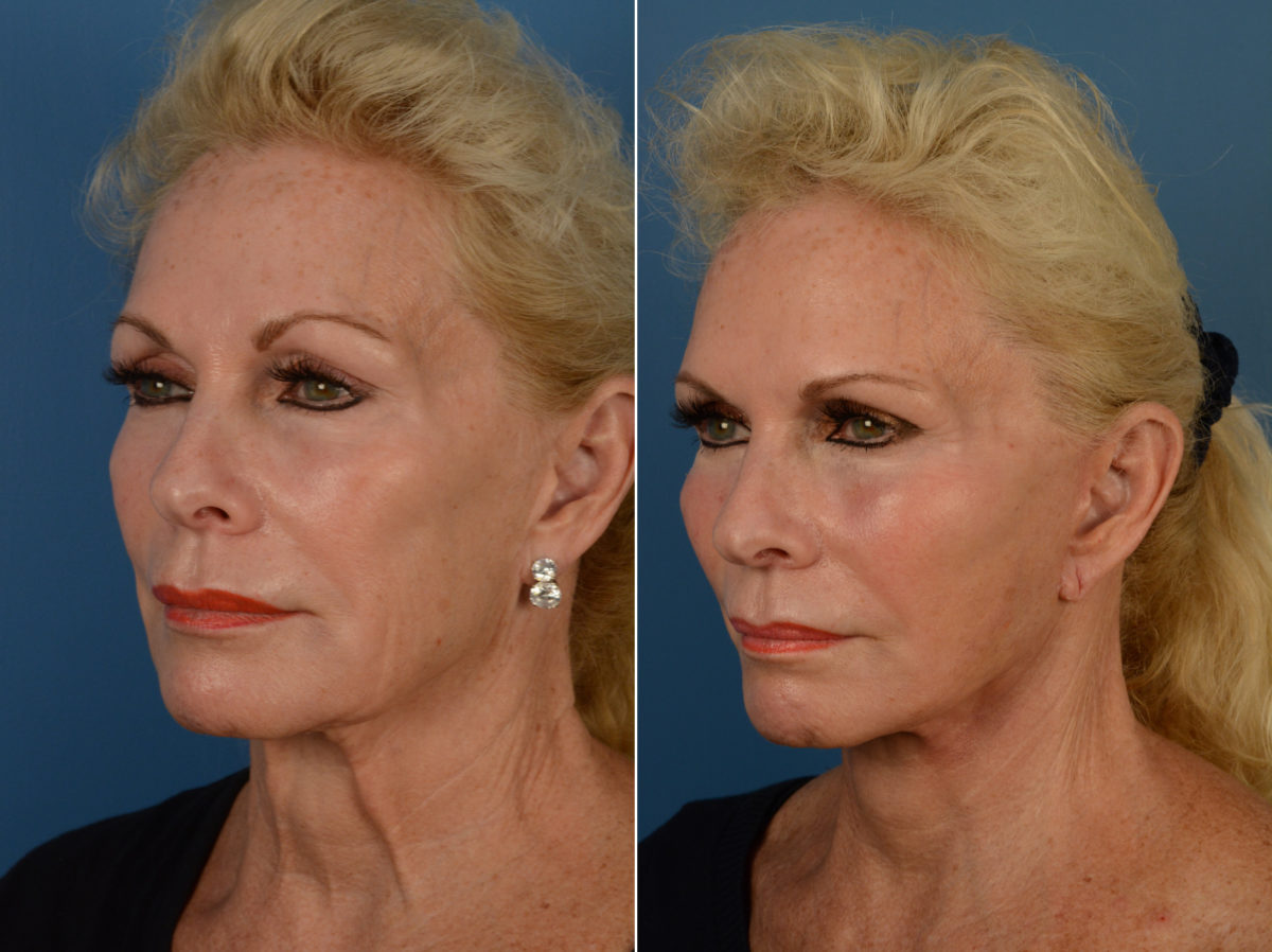 Cheek Implants Before and After Photos in Naples, FL, Patient 14446