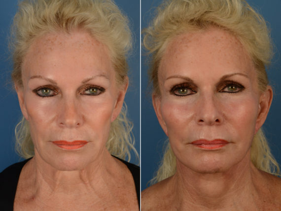 Cheek Implants Before and After Photos in Naples, FL, Patient 14446