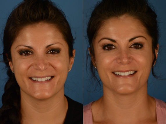 Revision Rhinoplasty Before and After Photos in Naples, FL, Patient 14496