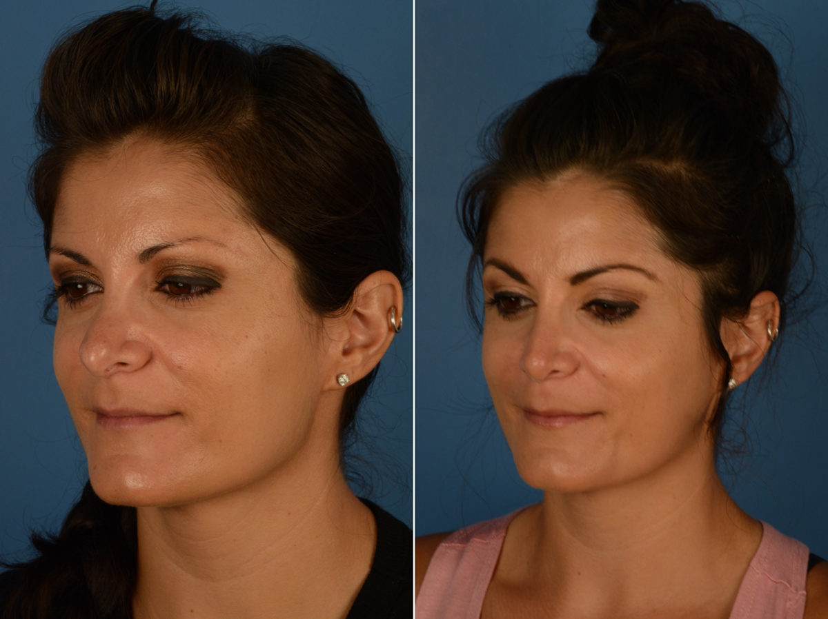 Revision Rhinoplasty Before and After Photos in Naples, FL, Patient 14496