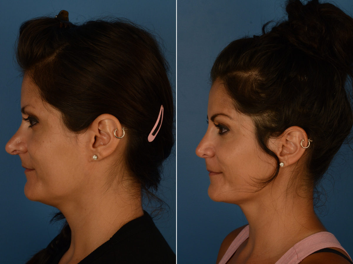 Revision Rhinoplasty Before and After Photos in Naples, FL, Patient 14496