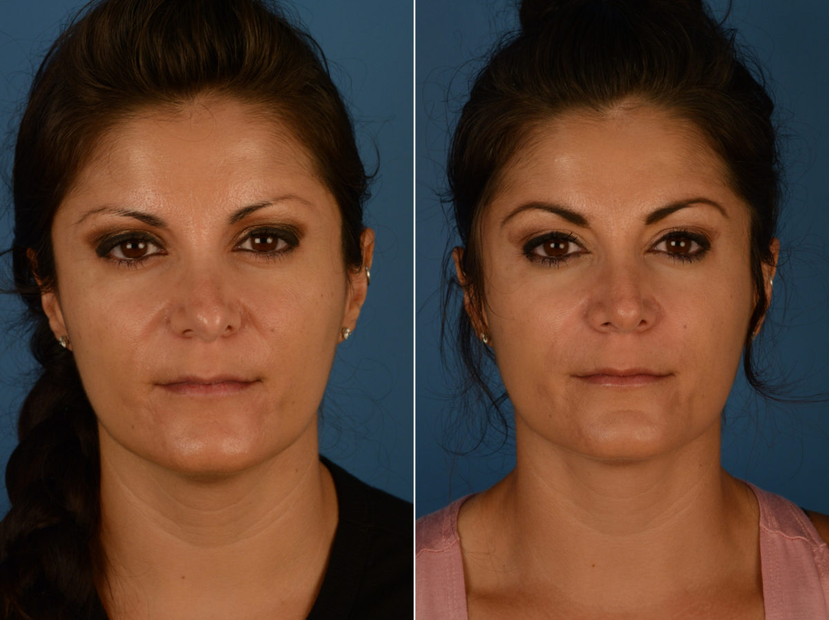 Revision Rhinoplasty Before and After Photos in Naples, FL, Patient 14496