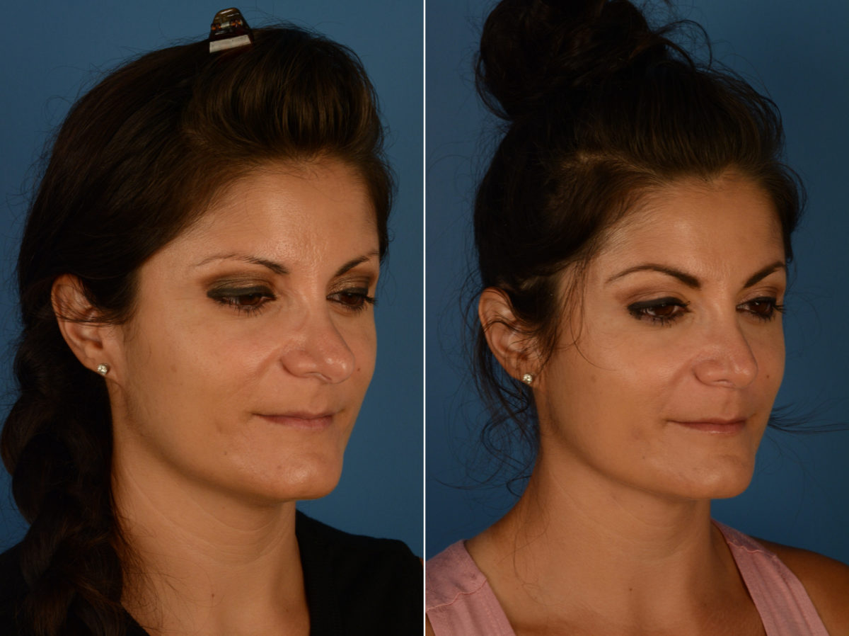 Revision Rhinoplasty Before and After Photos in Naples, FL, Patient 14496