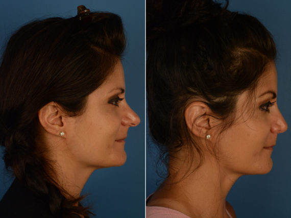 Revision Rhinoplasty Before and After Photos in Naples, FL, Patient 14496