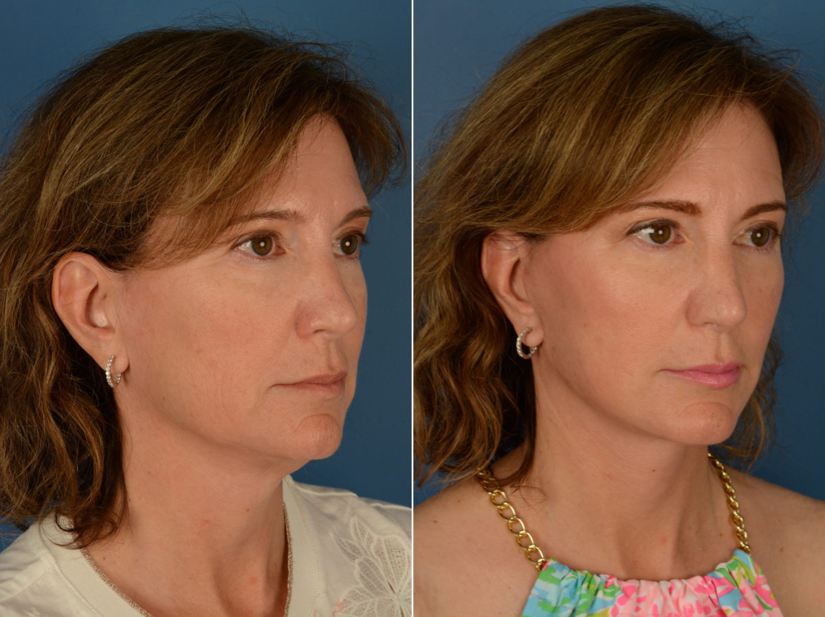 The UpLift™ Lower Face and Neck Lift Before and After Photos in Naples, FL, Patient 14515