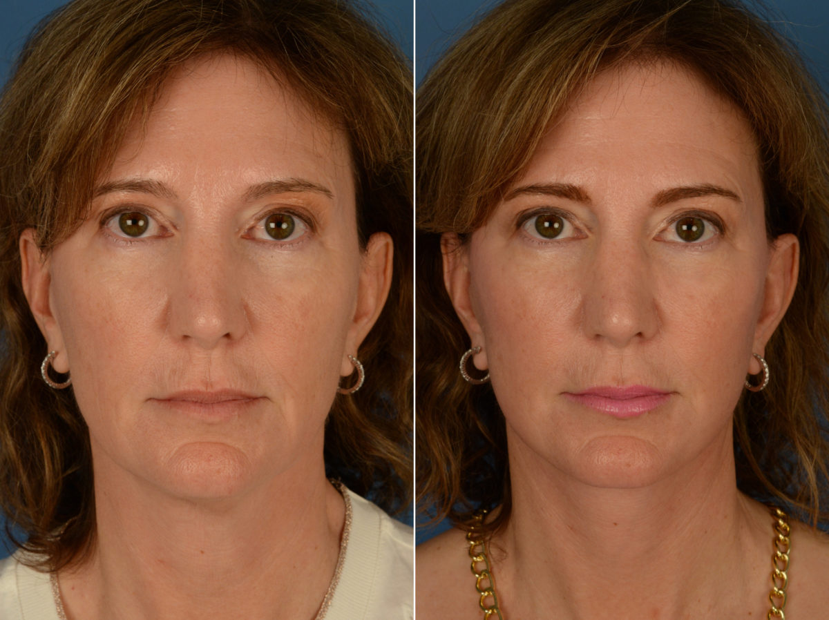 The UpLift™ Lower Face and Neck Lift Before and After Photos in Naples, FL, Patient 14515