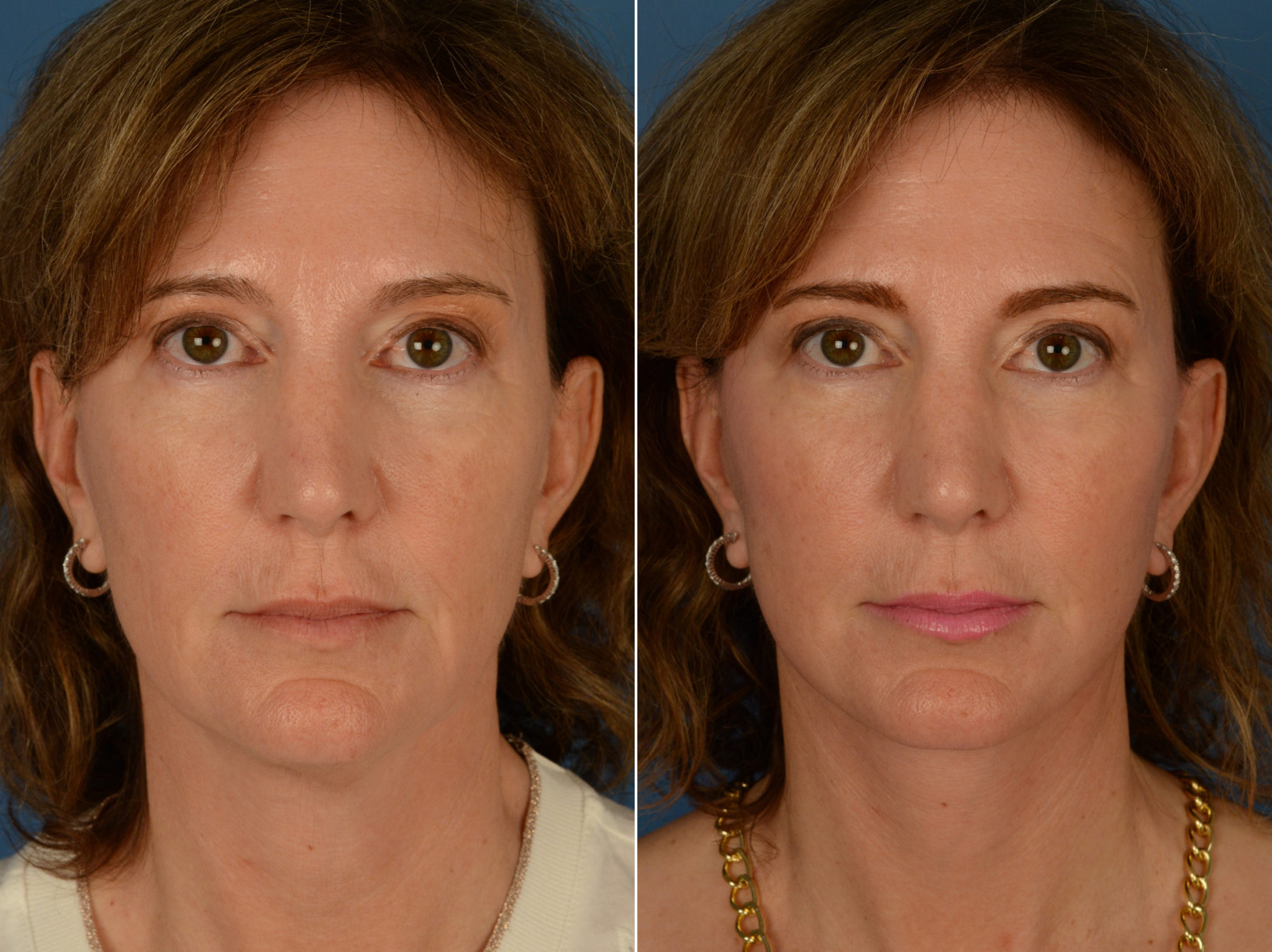 The UpLift™ Lower Face and Neck Lift Photos Naples, FL Patient 14515