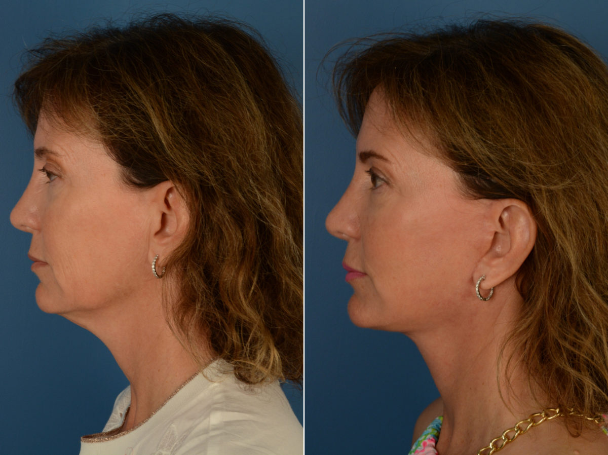 The UpLift™ Lower Face and Neck Lift Before and After Photos in Naples, FL, Patient 14515