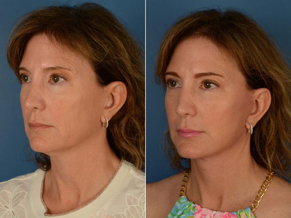 The UpLift™ Lower Face and Neck Lift Before and After Photos in Naples, FL, Patient 14515