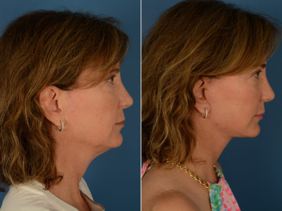 The UpLift™ Lower Face and Neck Lift Before and After Photos in Naples, FL, Patient 14515