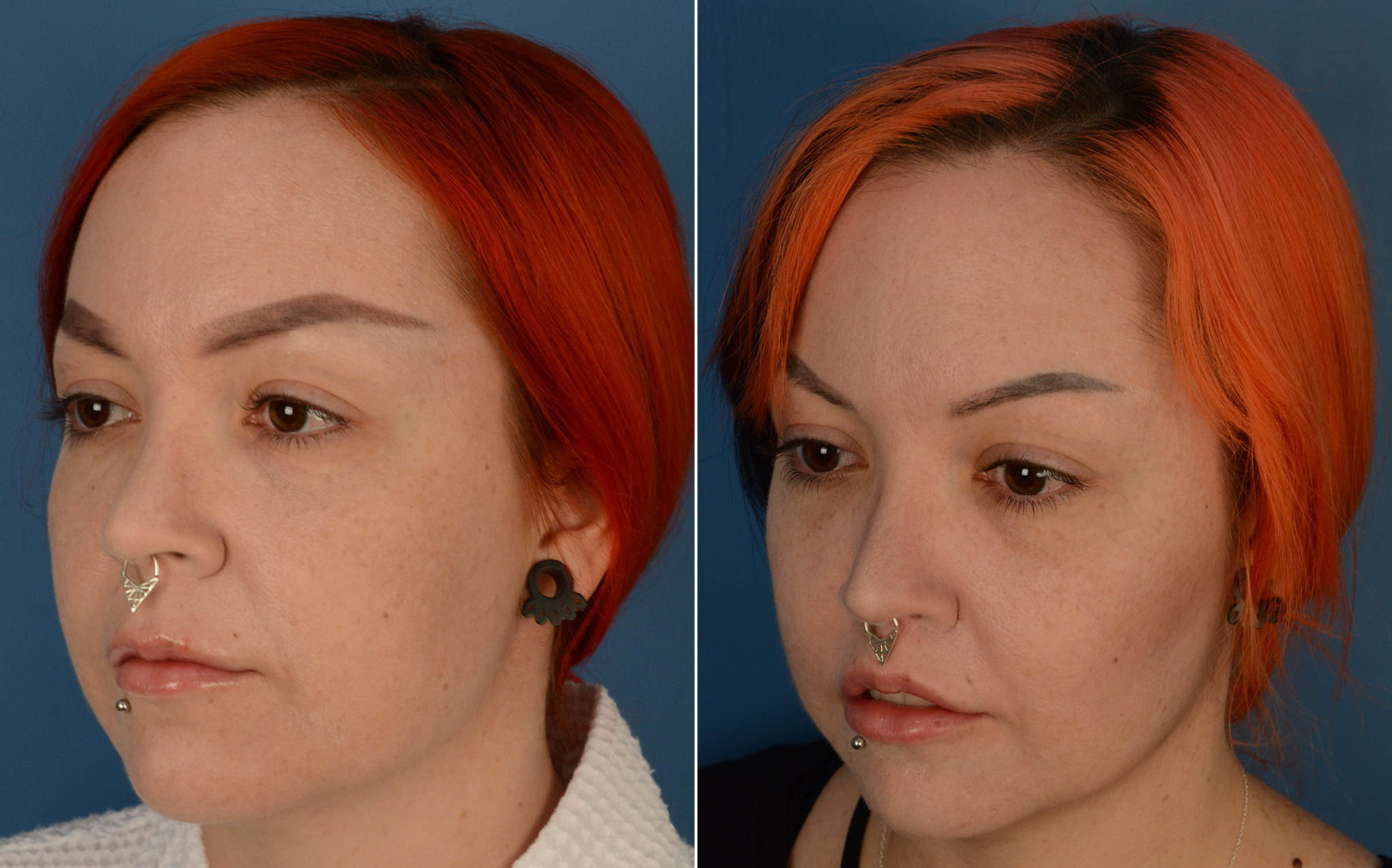 Lip Lift photos Aesthetic Surgery Center