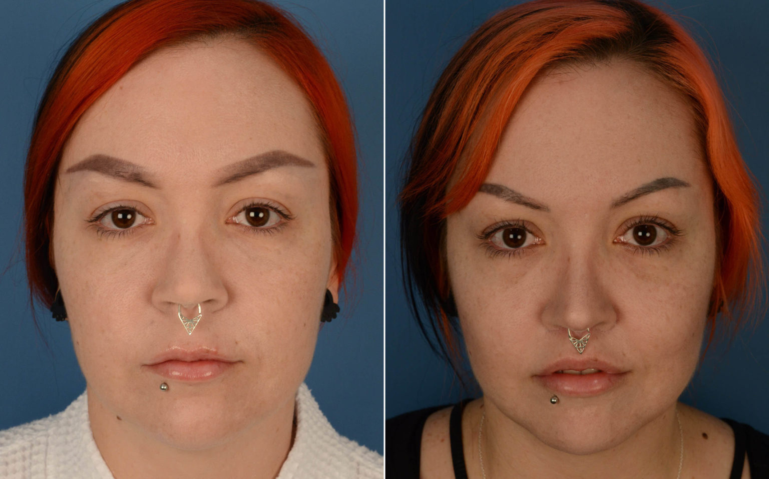 Lip Lift Photos Naples, FL Patient 14575