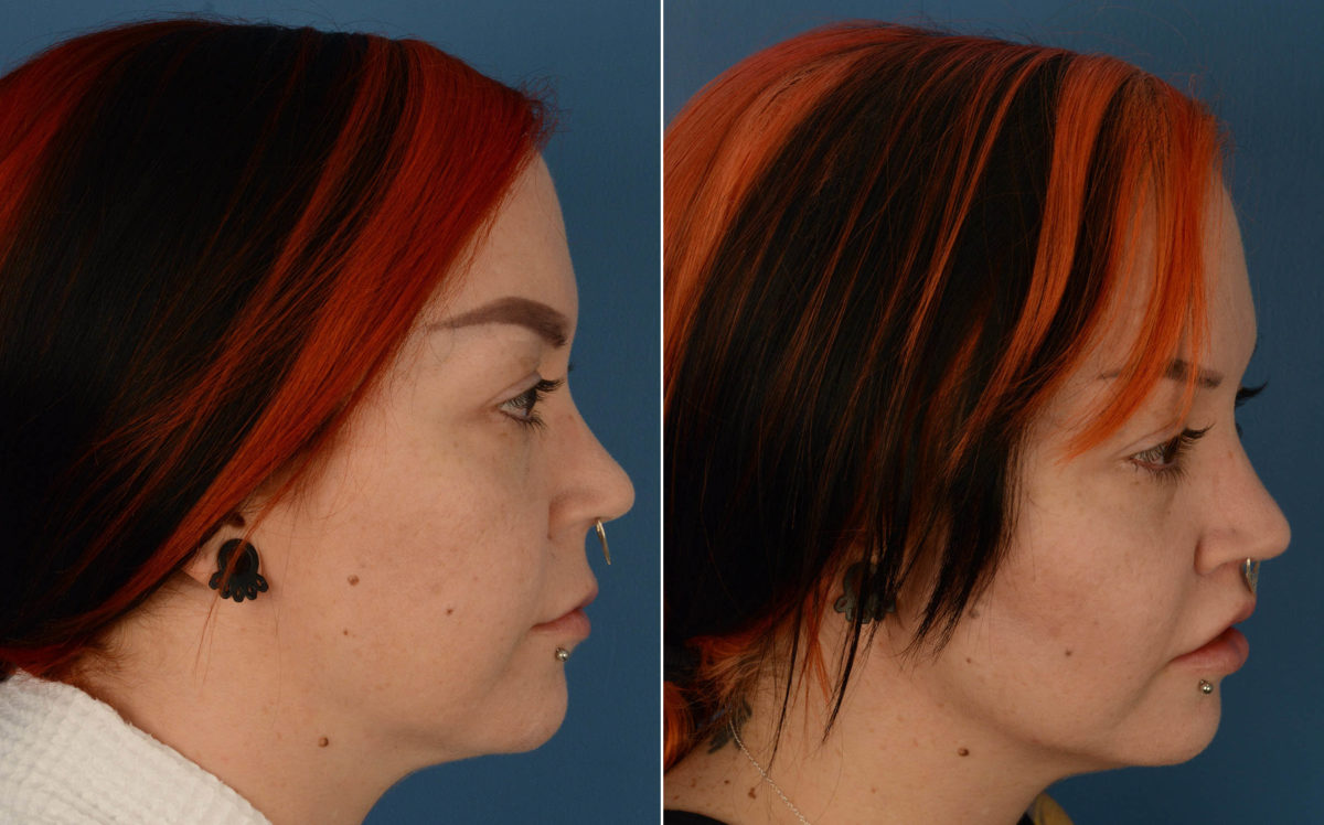 Lip Lift Before and After Photos in Naples, FL, Patient 14575