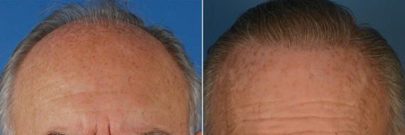 Hair Replacement Before and After Photos in Naples, FL, Patient 14745