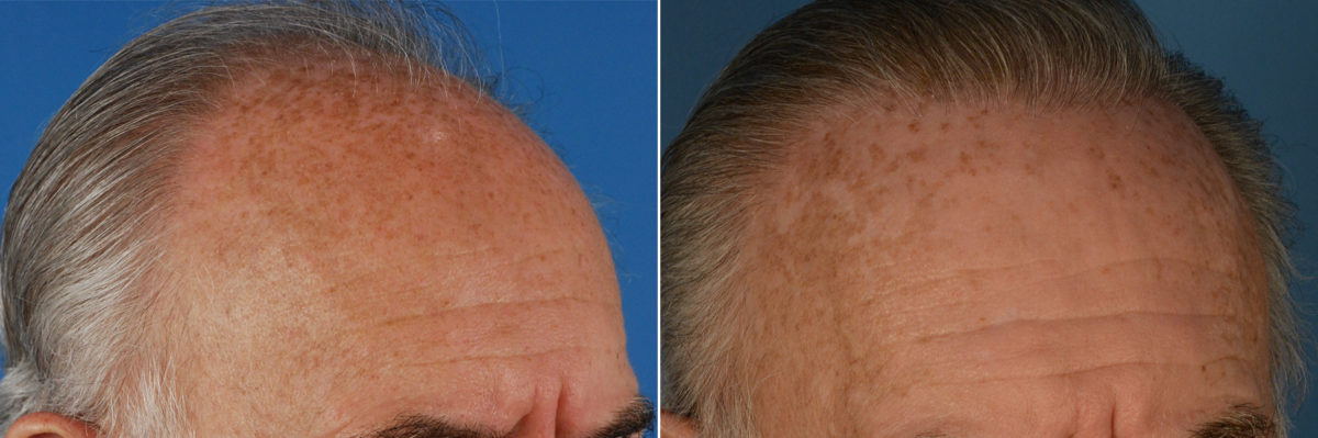 Hair Replacement Before and After Photos in Naples, FL, Patient 14745