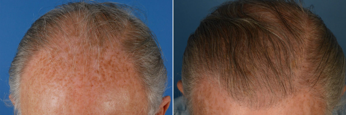 Hair Replacement Before and After Photos in Naples, FL, Patient 14745