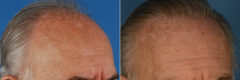 Hair Replacement Before and After Photos in Naples, FL, Patient 14745