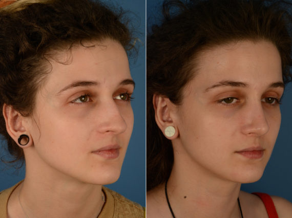 Rhinoplasty Before and After Photos in Naples, FL, Patient 14877