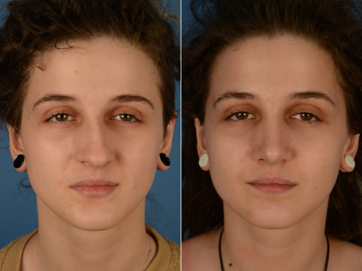 Rhinoplasty Before and After Photos in Naples, FL, Patient 14877