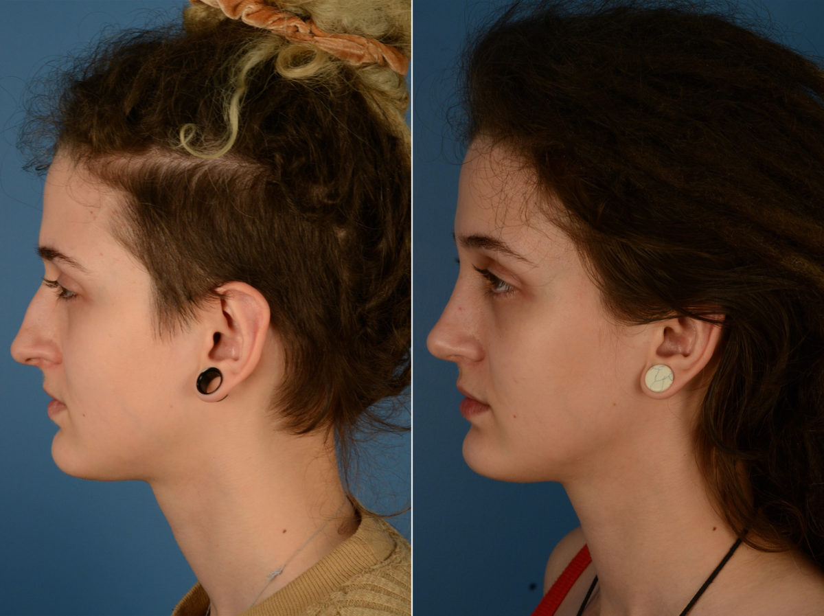 Rhinoplasty Before and After Photos in Naples, FL, Patient 14877