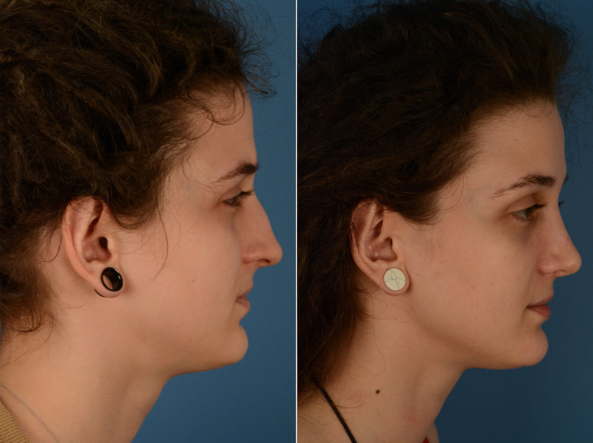 Rhinoplasty Before and After Photos in Naples, FL, Patient 14877
