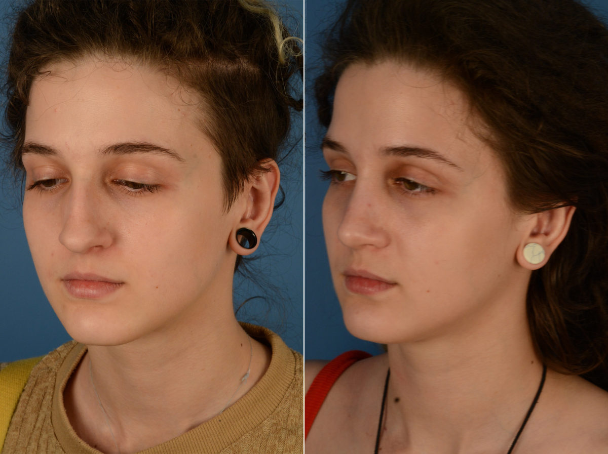 Rhinoplasty Before and After Photos in Naples, FL, Patient 14877