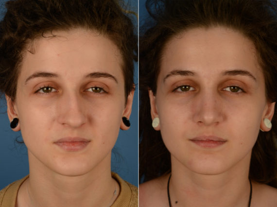 Rhinoplasty Before and After Photos in Naples, FL, Patient 14877