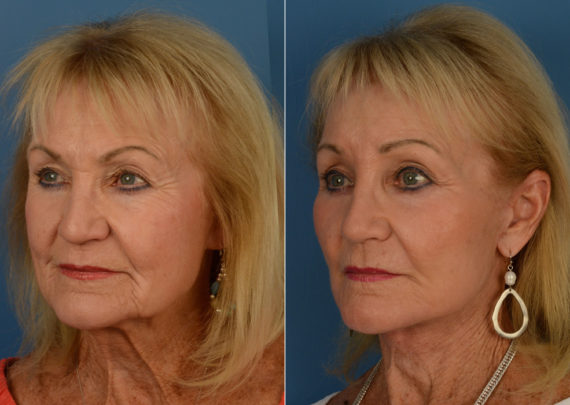 Endoscopic Facelift Before and After Photos in Naples, FL, Patient 14957