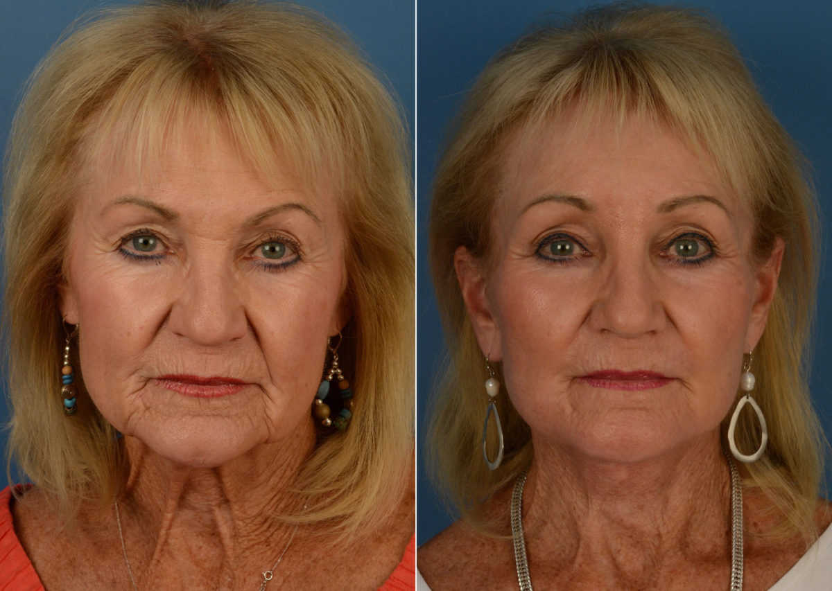 Endoscopic Facelift Before and After Photos in Naples, FL, Patient 14957