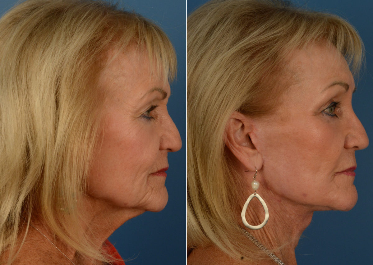 Endoscopic Facelift Before and After Photos in Naples, FL, Patient 14957