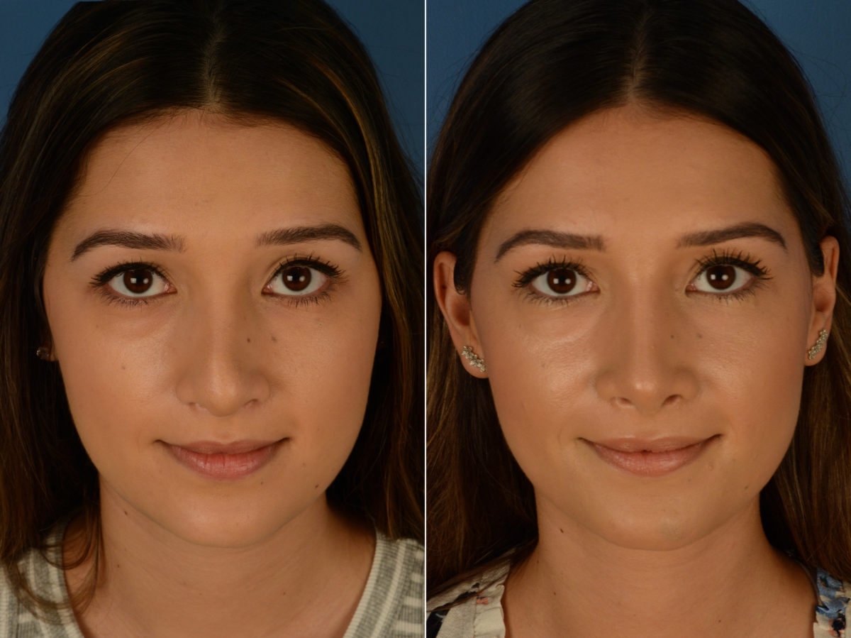 Revision Rhinoplasty Before and After Photos in Naples, FL, Patient 14996